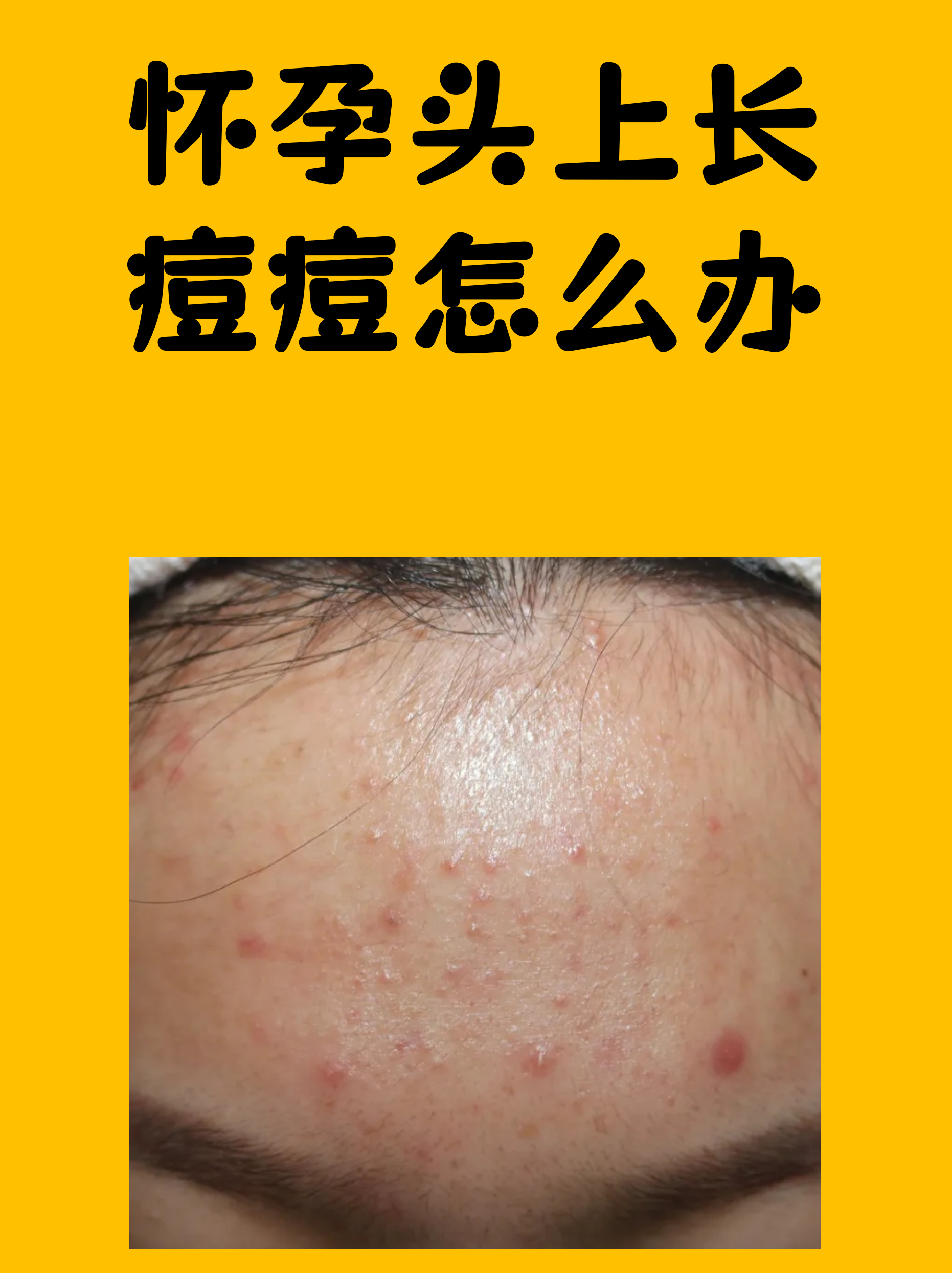 头皮长痘痘是什么原因(头发里头皮长痘痘是什么原因)