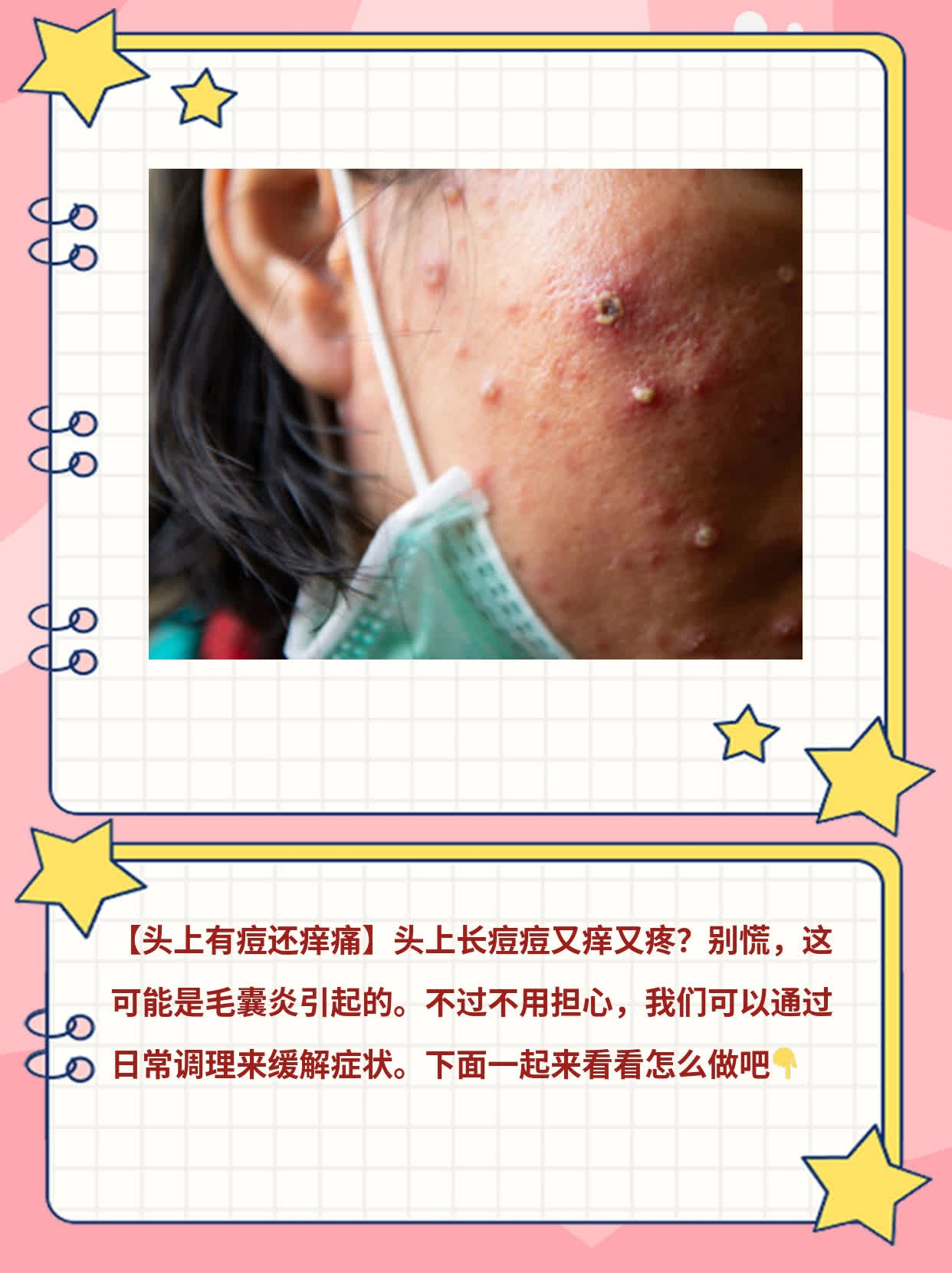 头皮长痘痘是什么原因(头发里头皮长痘痘是什么原因)