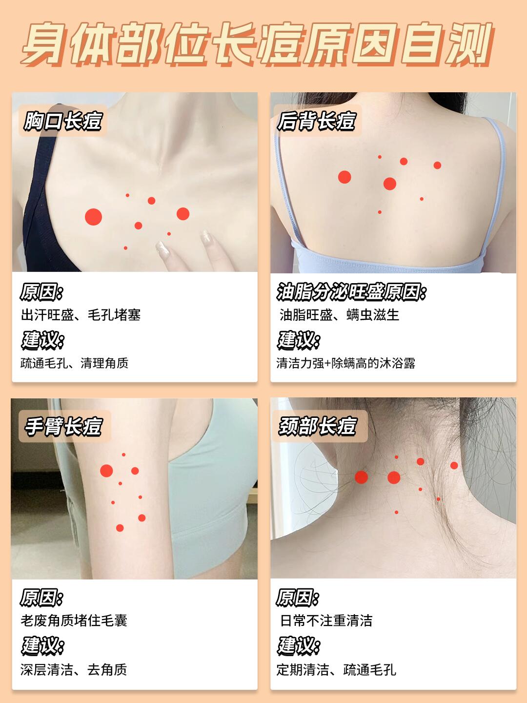 胸口长痘痘怎么办(胸口长痘痘怎么治)