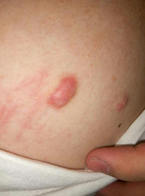 胸口长痘痘怎么办(胸口长痘痘怎么治)