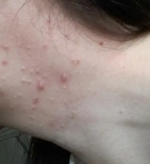 为什么脖子上会长痘痘(为什么脖子上会长痘痘不痛不痒)