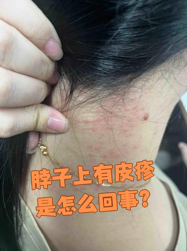 为什么脖子上会长痘痘(为什么脖子上会长痘痘不痛不痒)