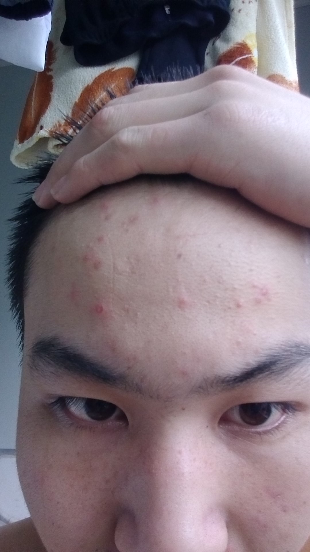 额头痘痘(额头痘痘用什么药膏)