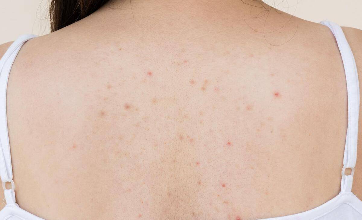 背部痘痘(背部痘痘怎么去除)