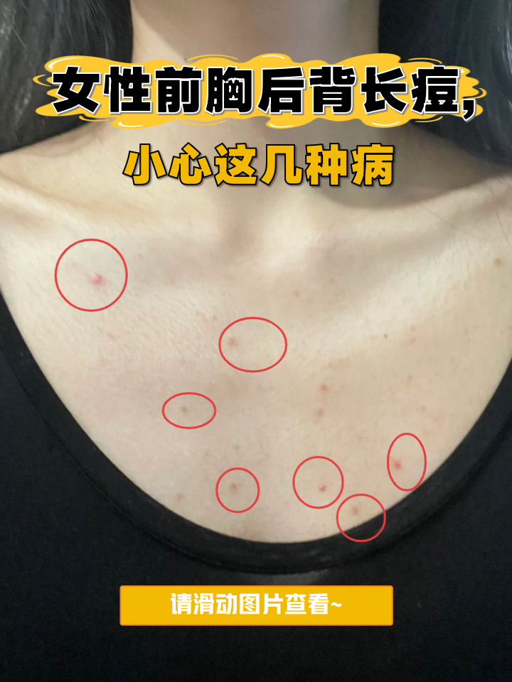 后背长痘痘是什么原因(前胸后背长痘痘是什么原因)